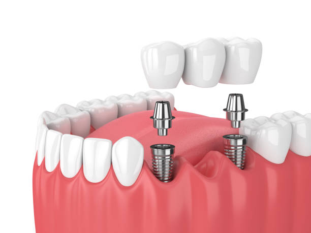 Tooth Replacement
