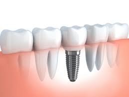 Dental Bridge
