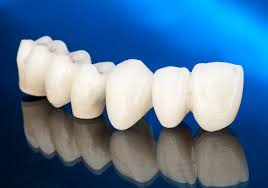Types of Dental Bridge
