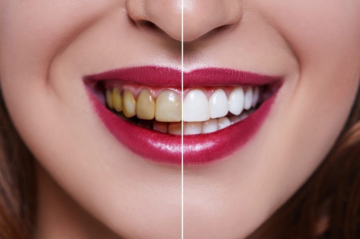 Dental veneers treatment
